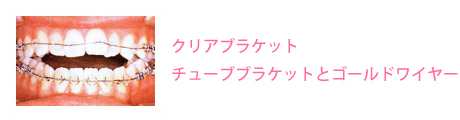 クリアブラケット・チューブブラケットとゴールドワイヤー