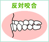 反対咬合